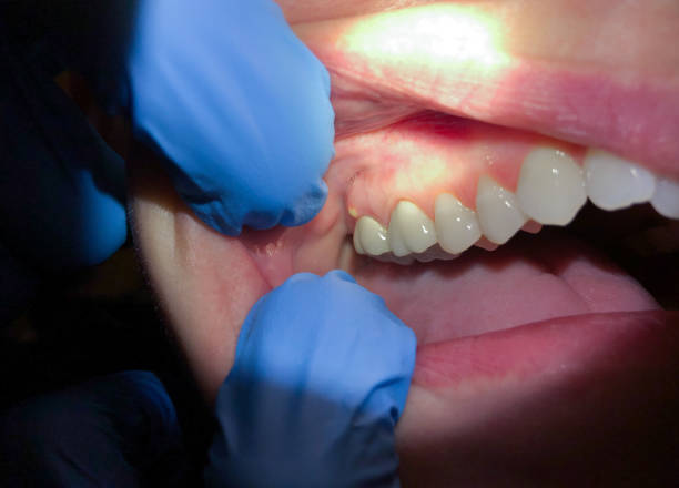 Best Emergency Treatment for Oral Infections in Salem Lakes, WI