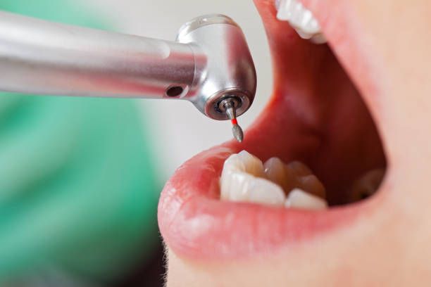 Best Emergency Wisdom Tooth Extraction in Salem Lakes, WI